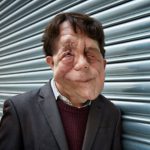 Actor Adam Pearson – who has neurofibromatosis type 1