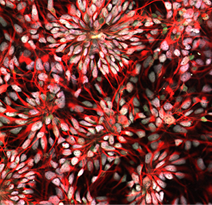 Neural progenitor cells derived from stem cells of a person with Down syndrome.